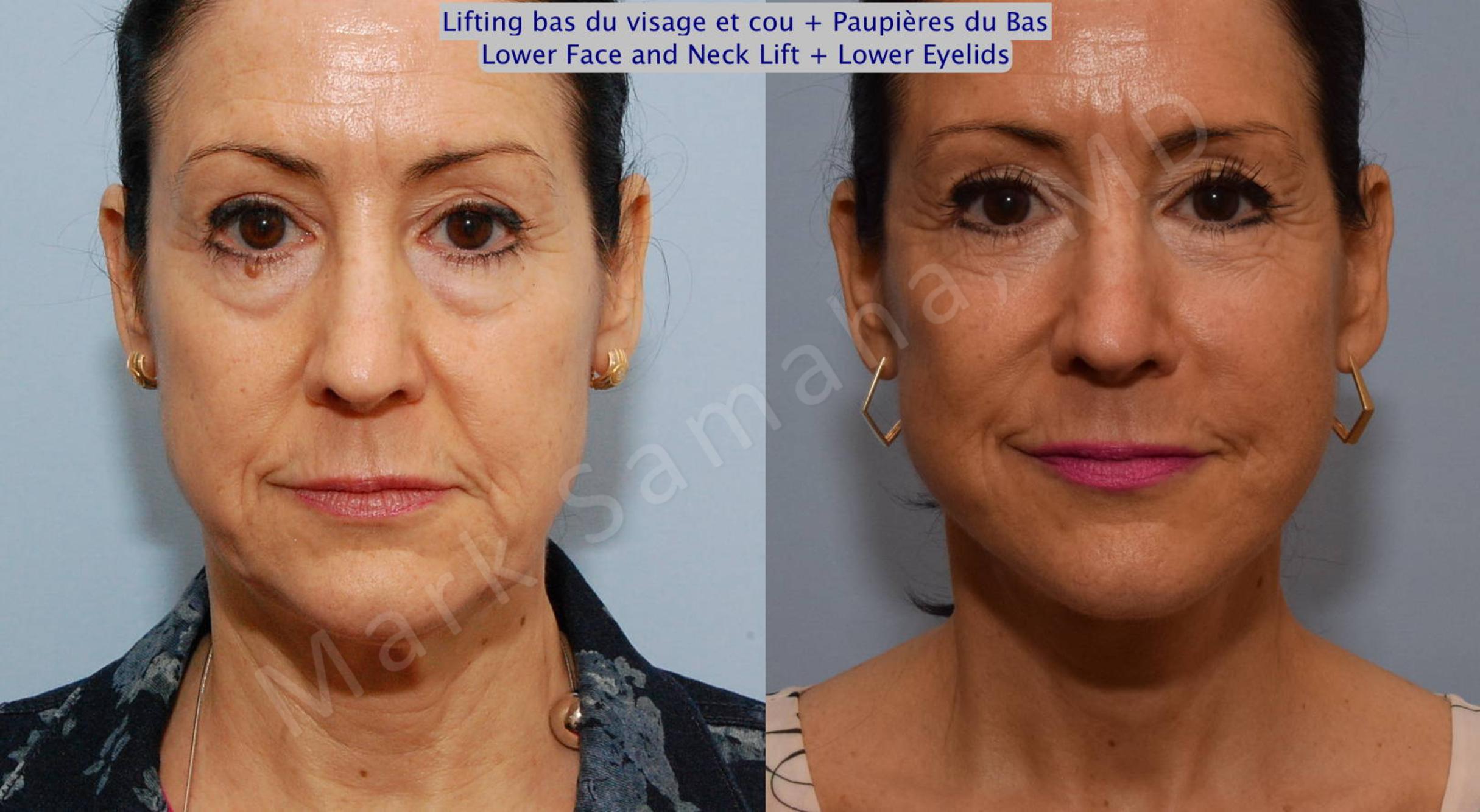 Before & After Facelift / Necklift - Lifting du visage / Cou Case 69 View #1 View in Mount Royal, QC