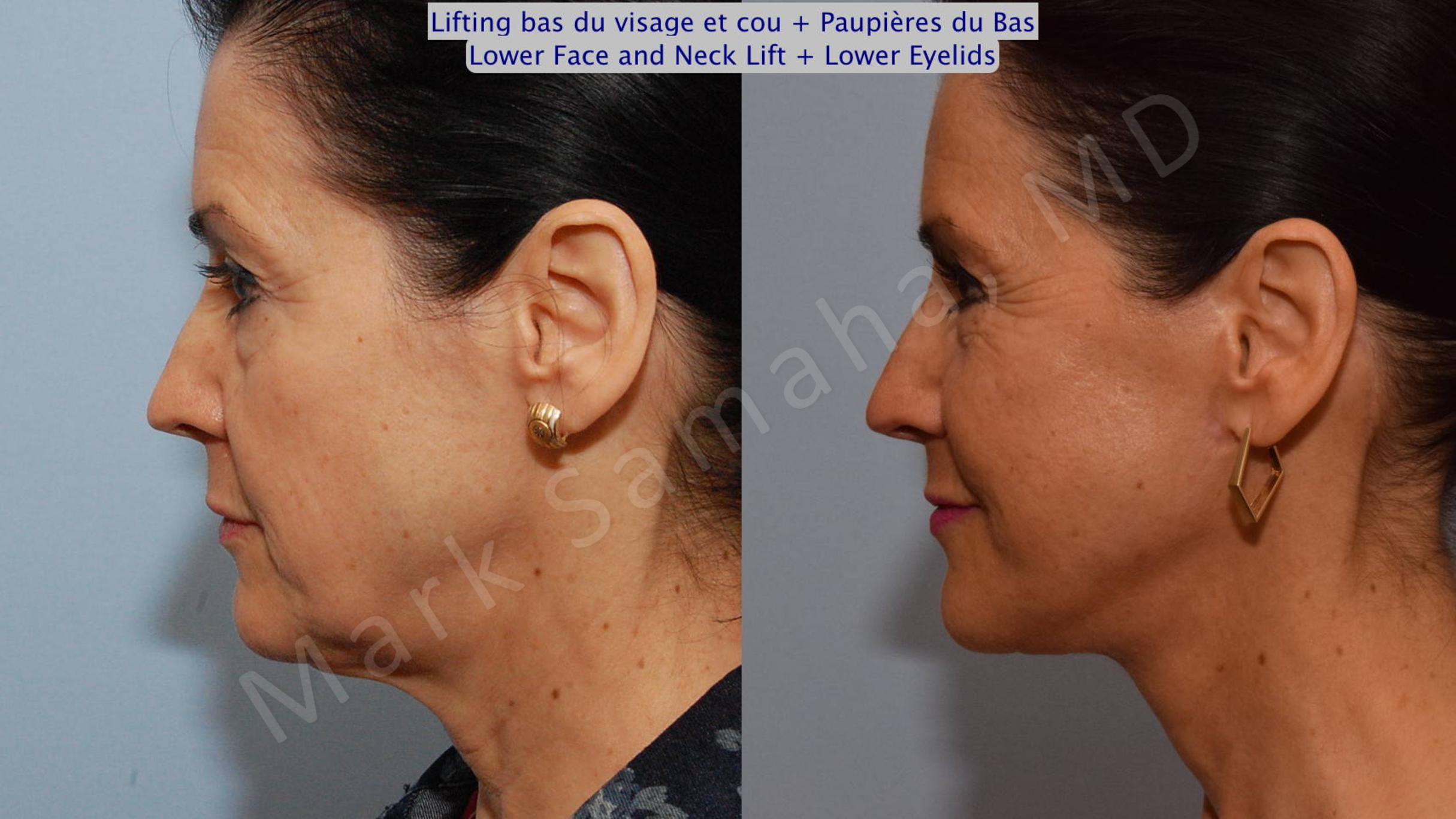 Before & After Blepharoplasty / Blépharoplastie Case 69 View #3 View in Mount Royal, QC