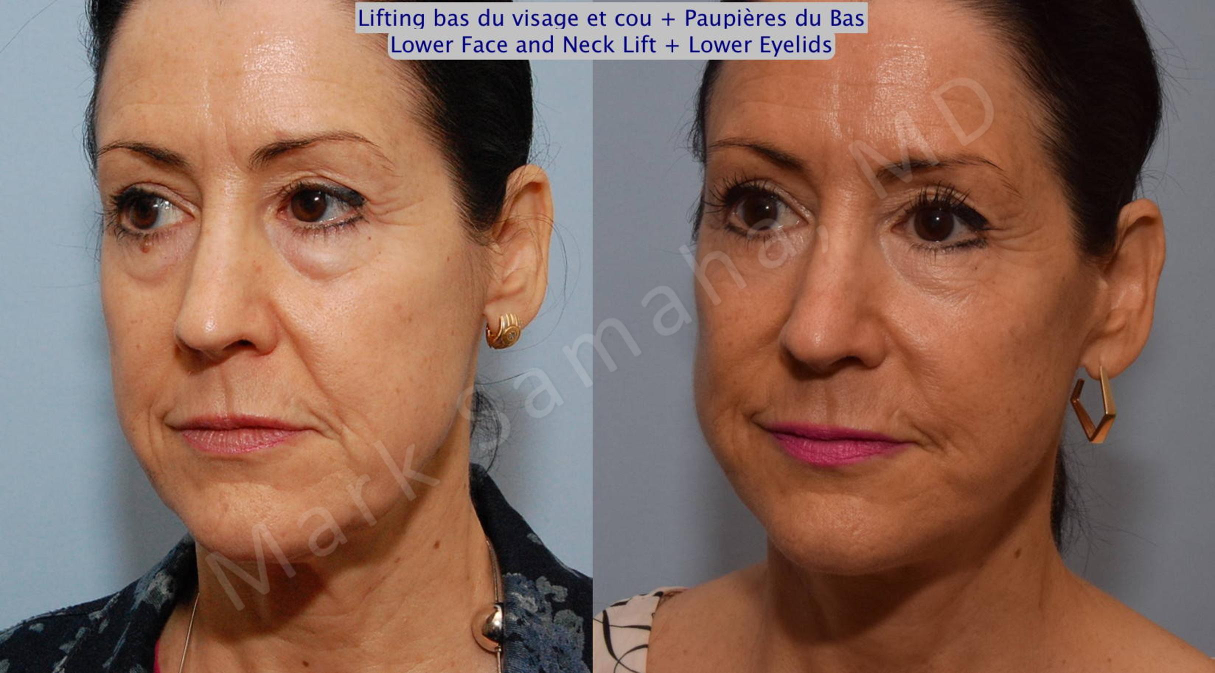 Before & After Blepharoplasty / Blépharoplastie Case 69 View #5 View in Mount Royal, QC