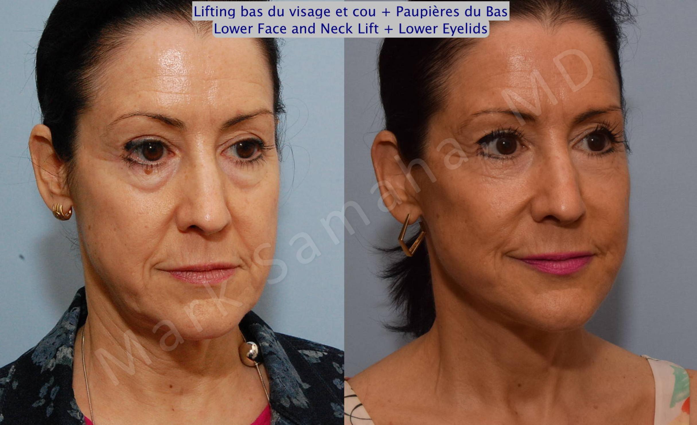 Before & After Lifting du visage / Cou - Facelift / Necklift Case 69 View #6 View in Mount Royal, QC