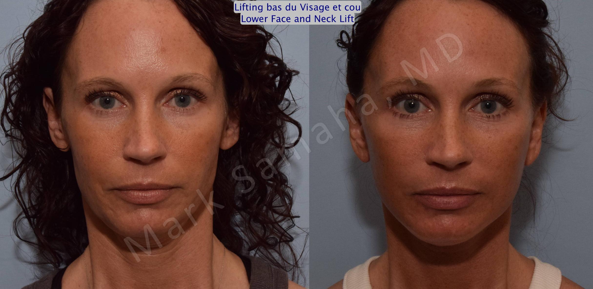 Before & After Facelift / Necklift - Lifting du visage / Cou Case 88 View #1 View in Mount Royal, QC