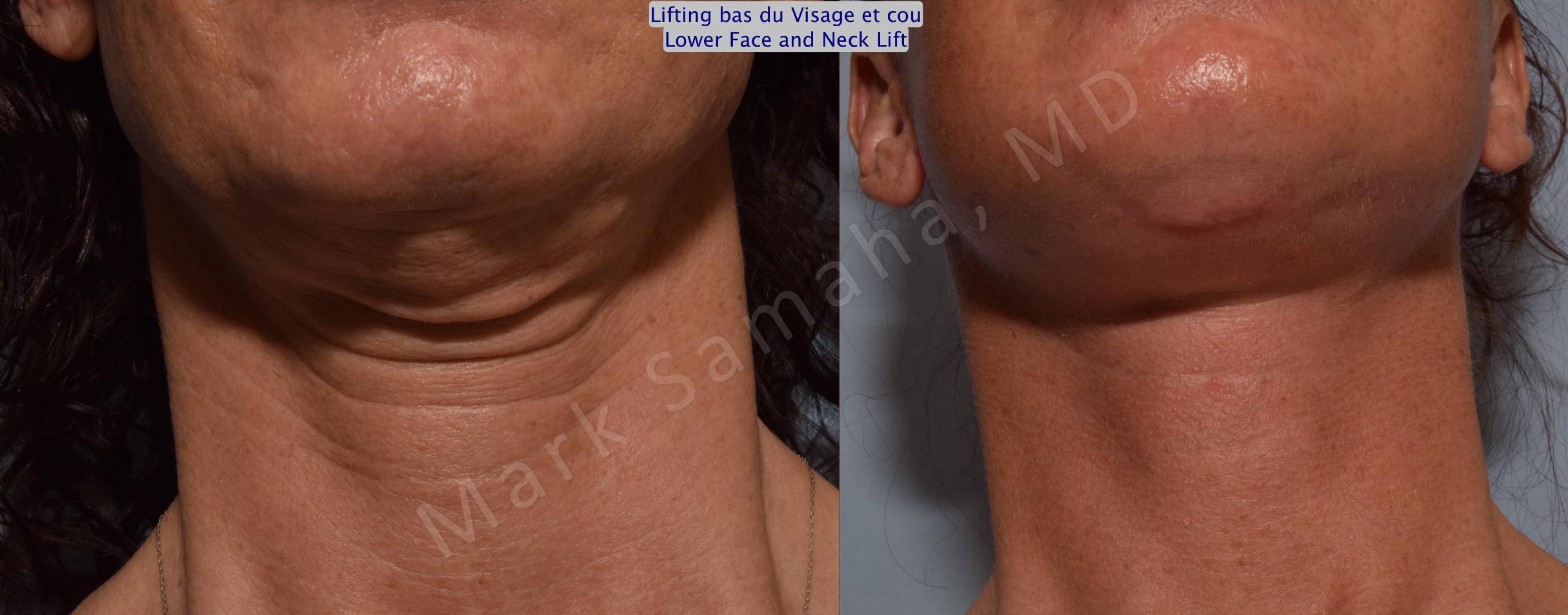 Before & After Facelift / Necklift - Lifting du visage / Cou Case 88 View #2 View in Mount Royal, QC