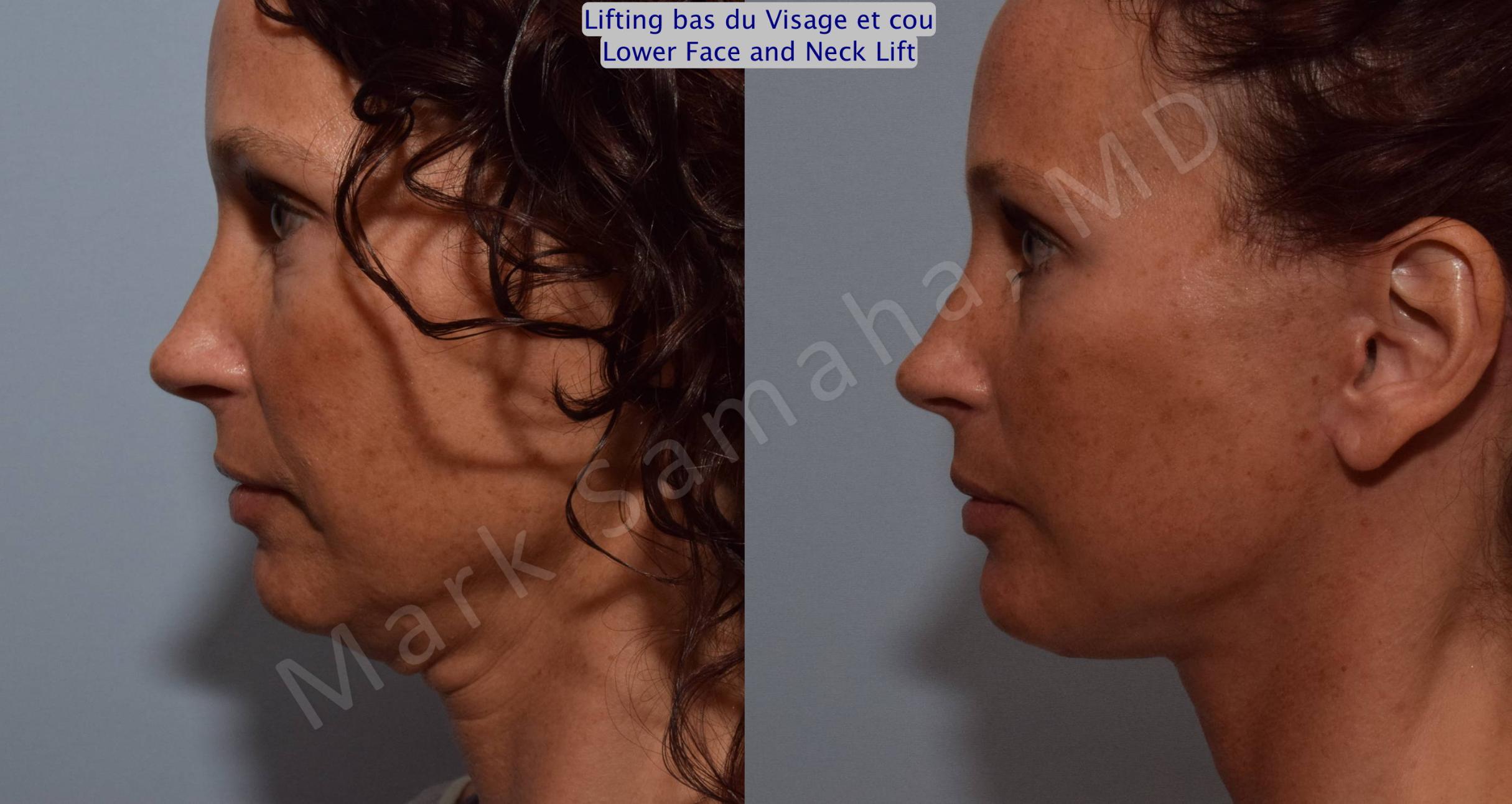 Before & After Lifting du visage / Cou - Facelift / Necklift Case 88 View #3 View in Mount Royal, QC