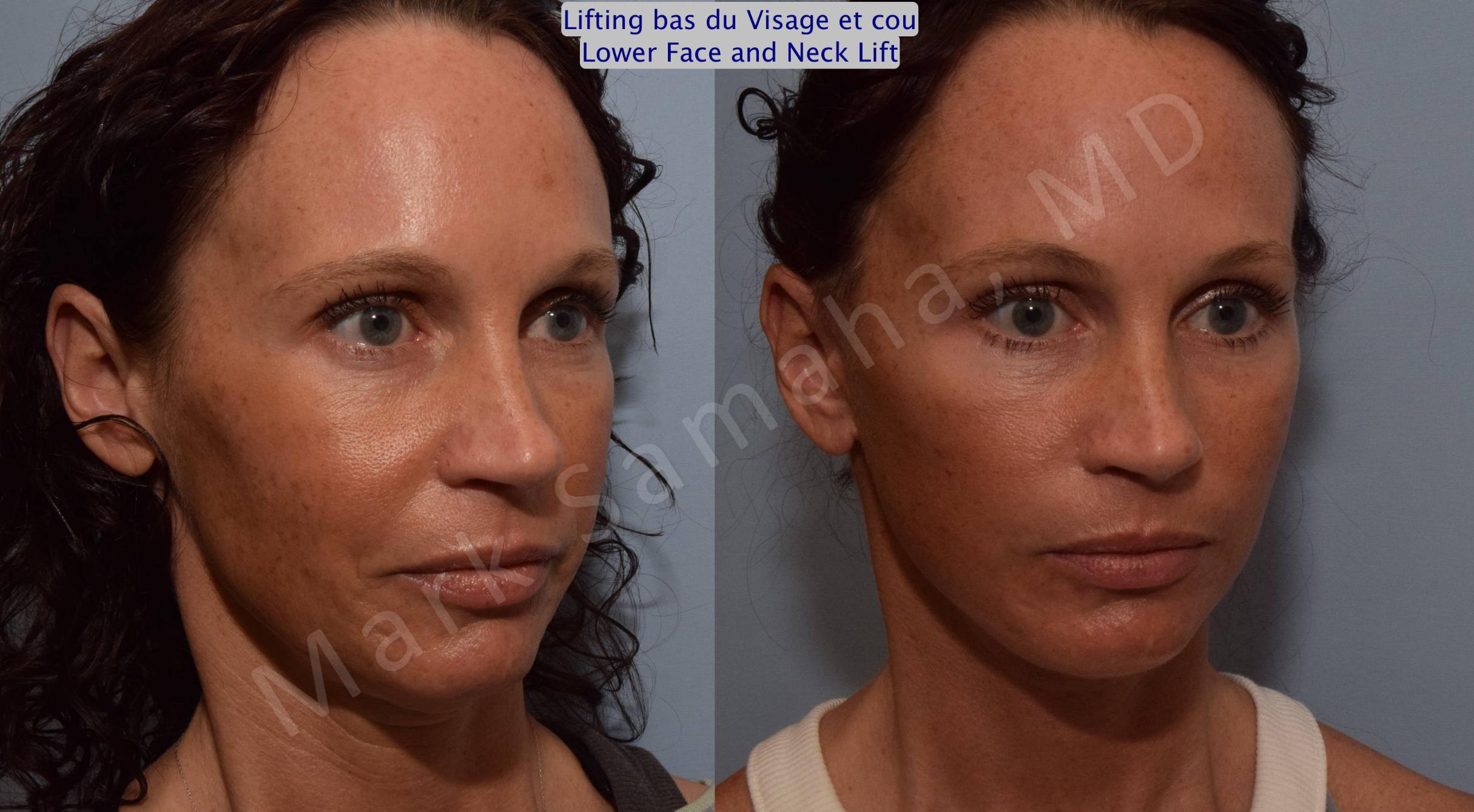 Before & After Lifting du visage / Cou - Facelift / Necklift Case 88 View #6 View in Mount Royal, QC