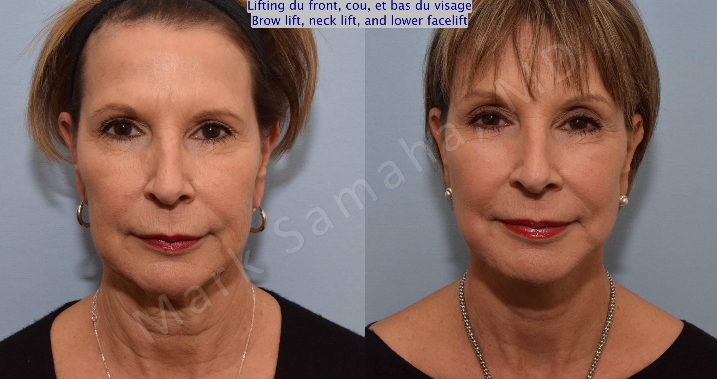 Before & After Lifting du visage / Cou - Facelift / Necklift Case 92 View #1 View in Mount Royal, QC