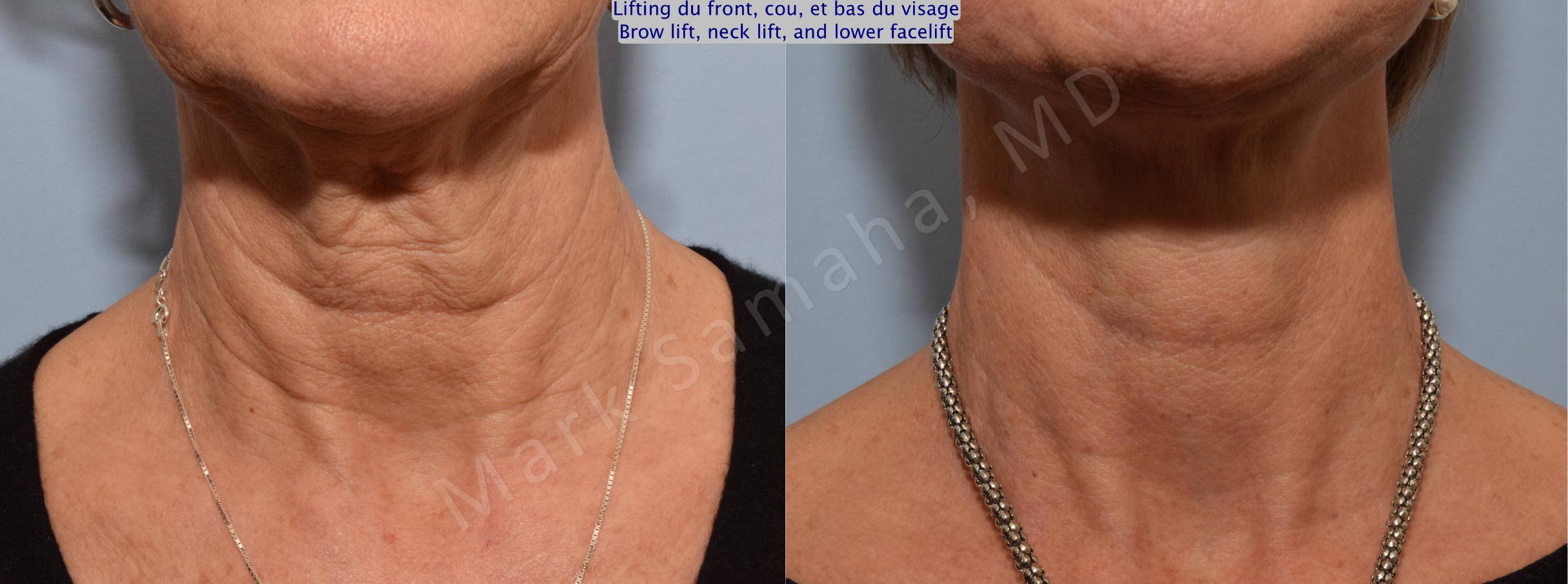 Before & After Facelift / Necklift - Lifting du visage / Cou Case 92 View #2 View in Mount Royal, QC