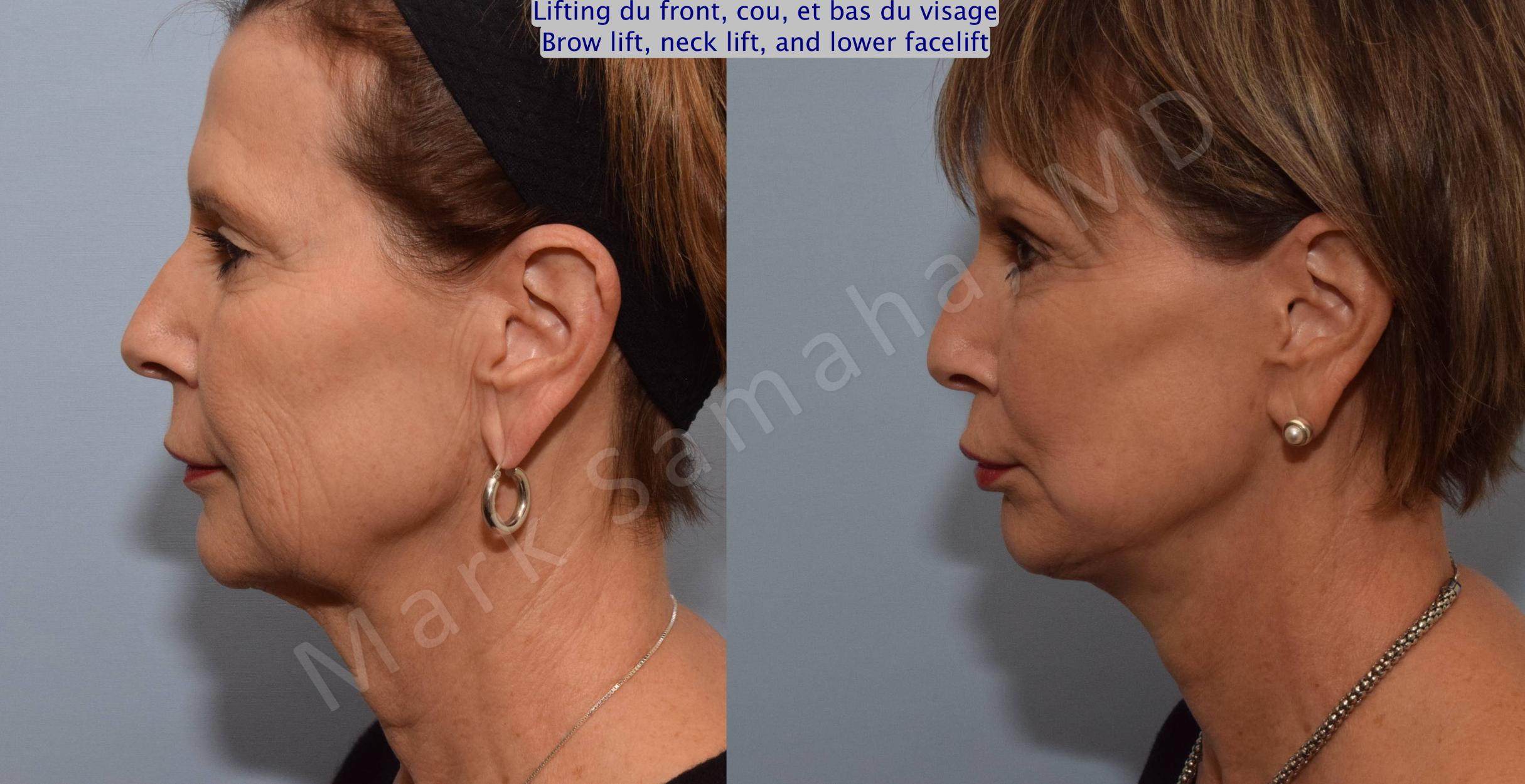 Before & After Lifting du Sourcil / Brow lift Case 92 View #3 View in Mount Royal, QC