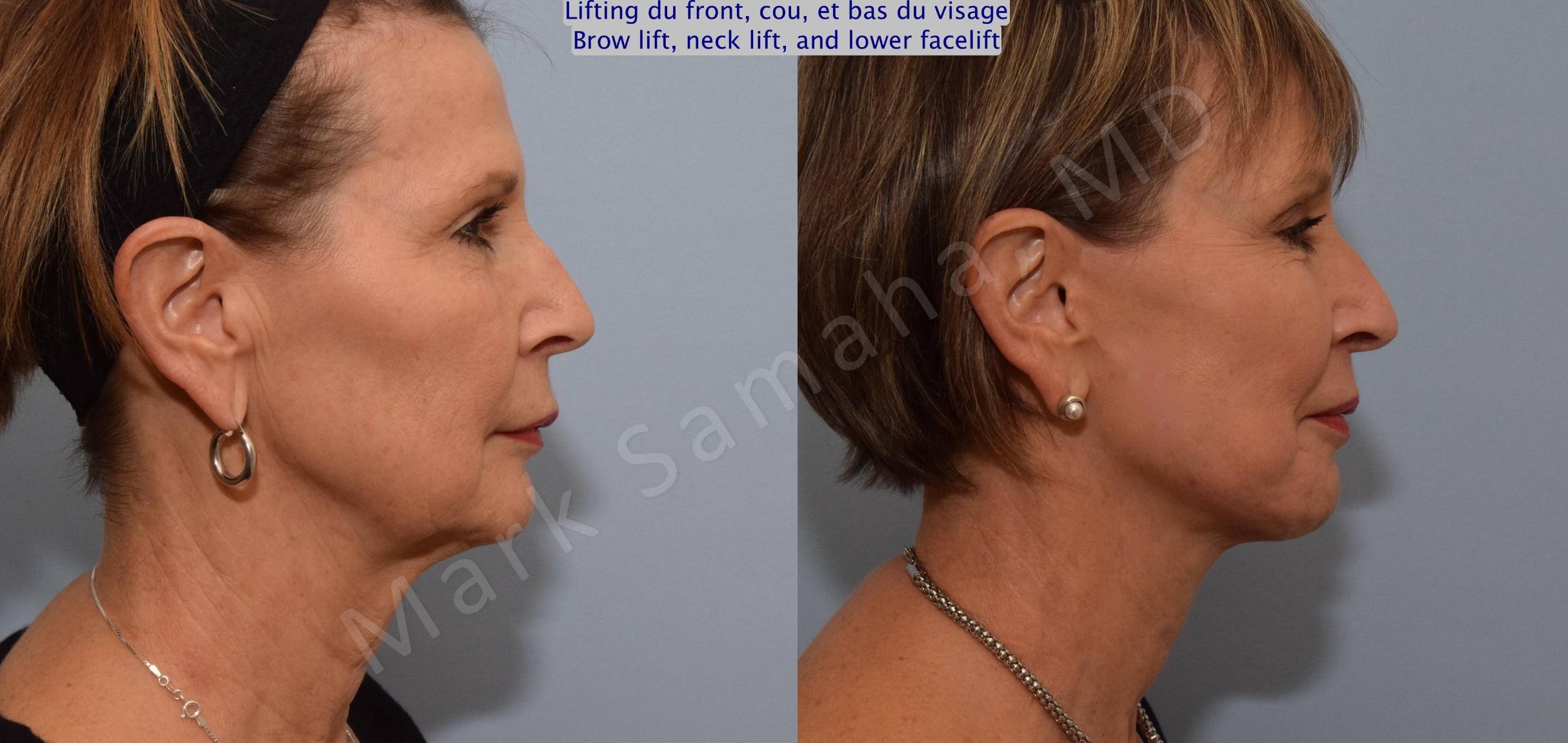 Before & After Lifting du Sourcil / Brow lift Case 92 View #4 View in Mount Royal, QC