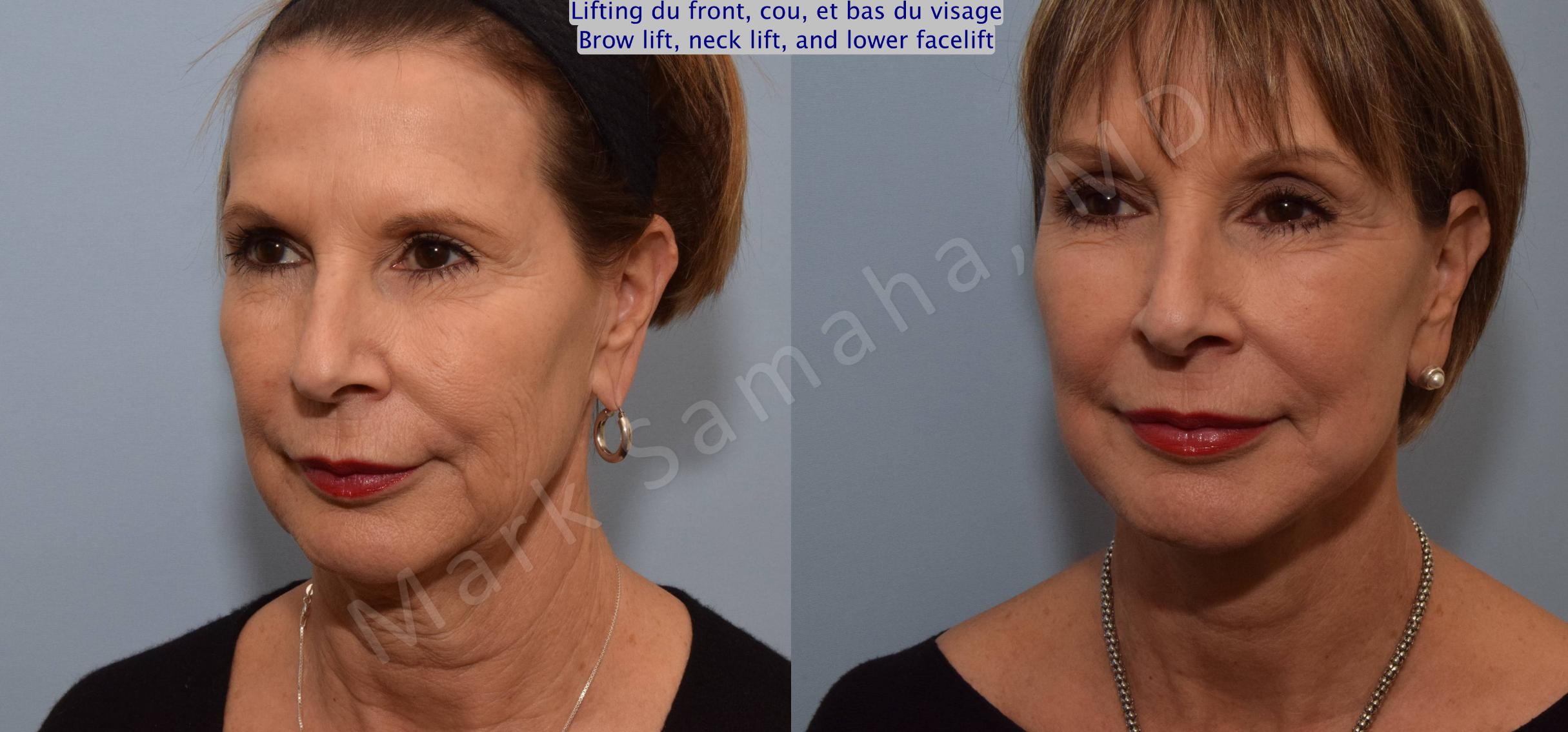 Before & After Lifting du visage / Cou - Facelift / Necklift Case 92 View #5 View in Mount Royal, QC