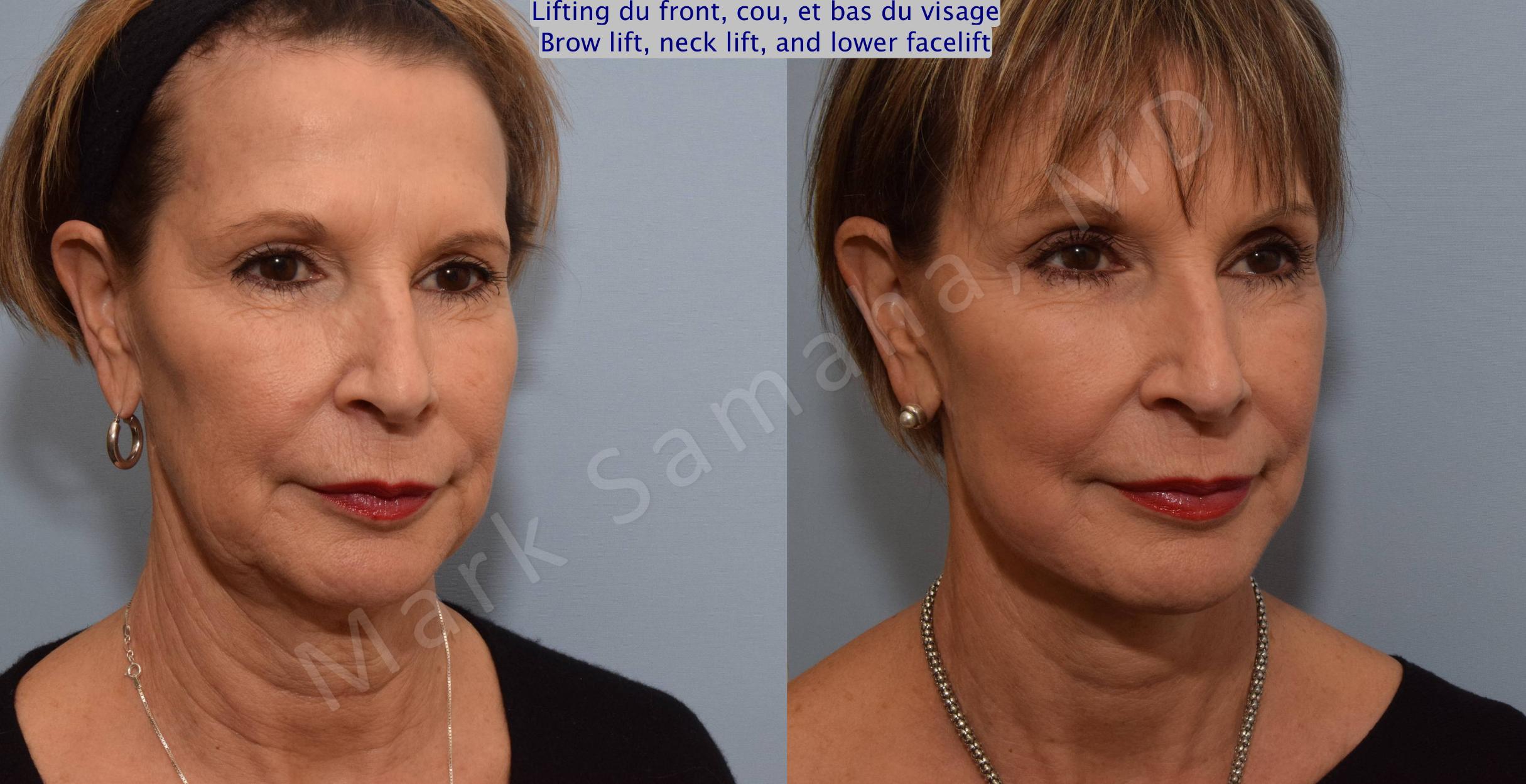 Before & After Facelift / Necklift - Lifting du visage / Cou Case 92 View #6 View in Mount Royal, QC
