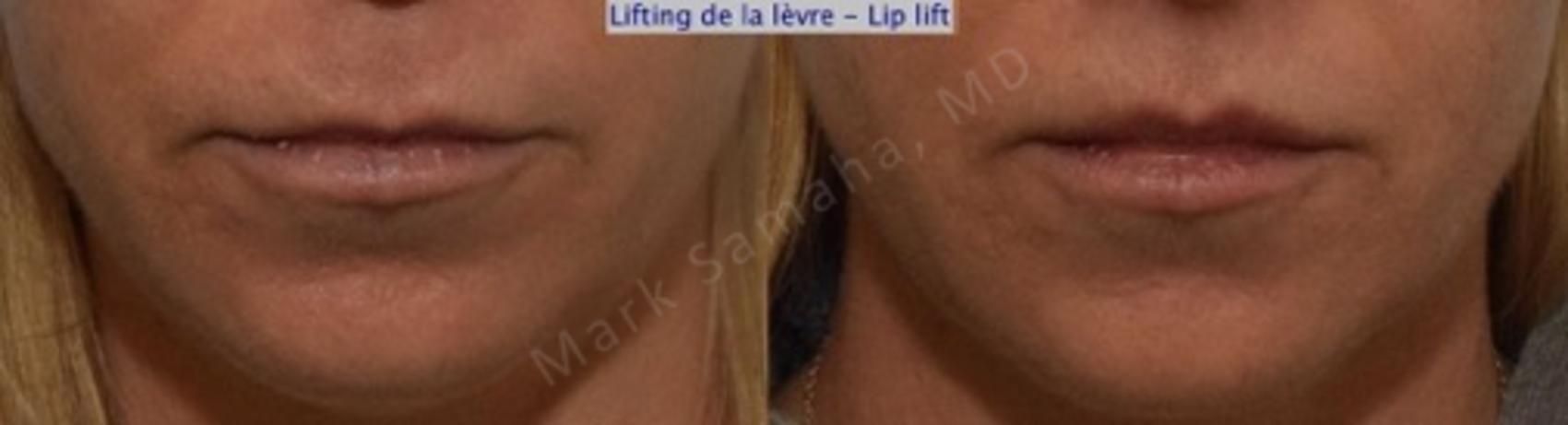 Before & After Lifting de la lèvre supérieure / Lip Lift  Case 115 View #1 View in Montreal, QC