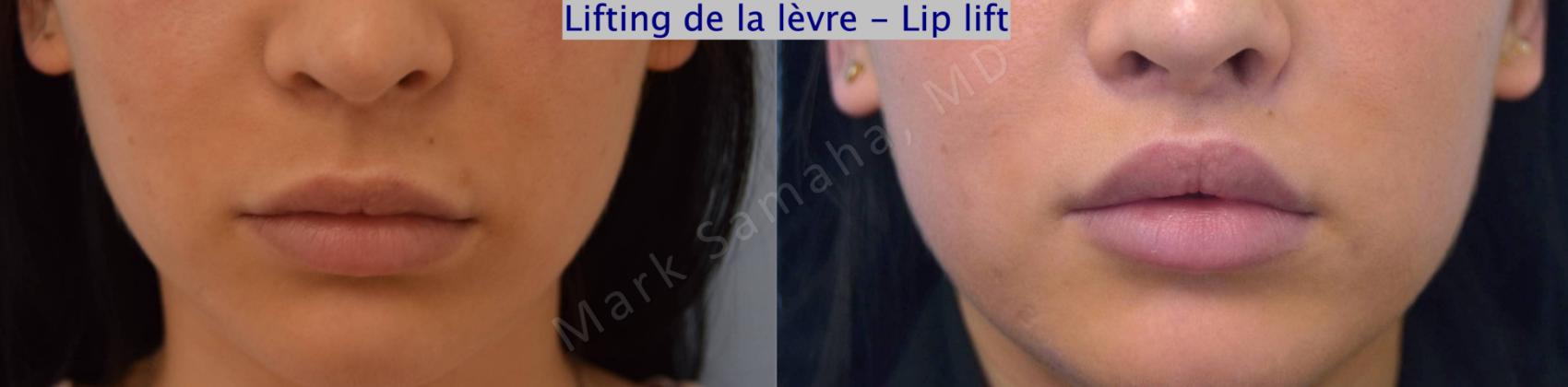 Before & After Lifting de la lèvre supérieure / Lip Lift  Case 122 View #1 View in Montreal, QC