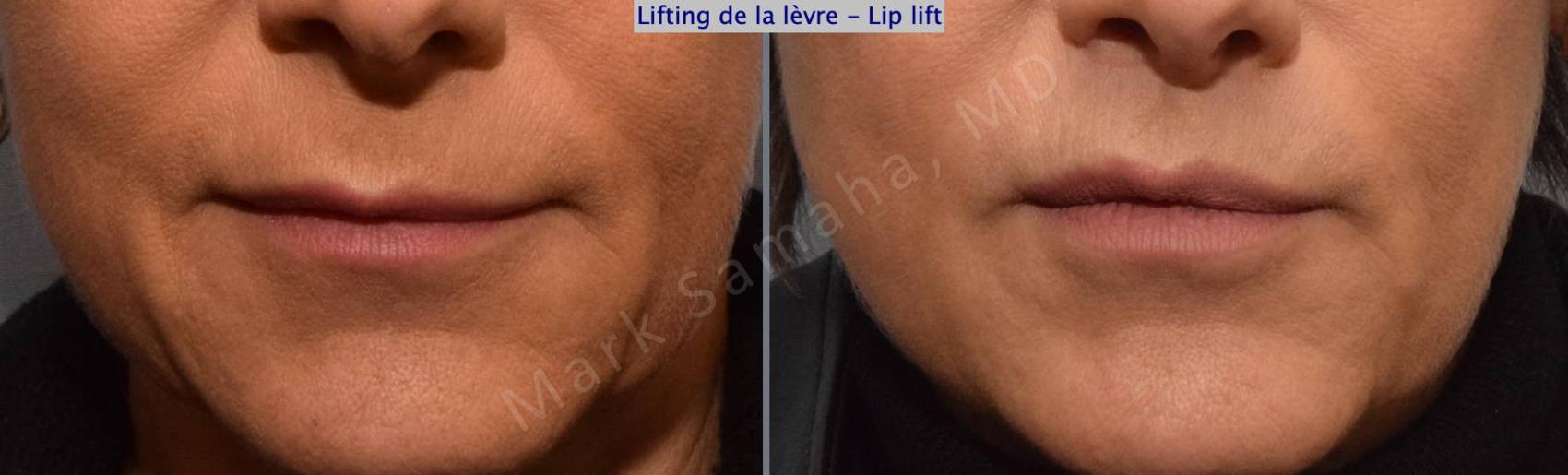 Before & After Lifting de la lèvre supérieure / Lip Lift  Case 124 View #1 View in Montreal, QC