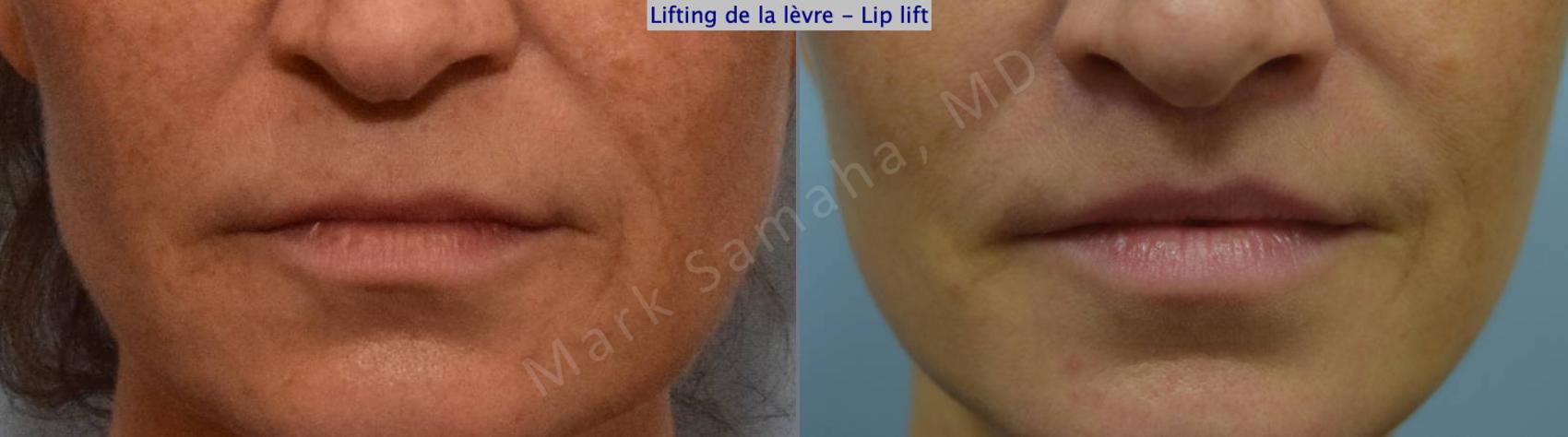Before & After Lifting de la lèvre supérieure / Lip Lift  Case 131 View #1 View in Montreal, QC
