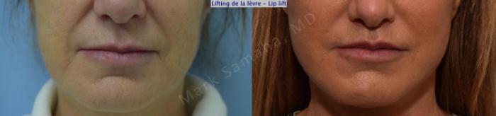 Before & After Lifting de la lèvre supérieure / Lip Lift  Case 168 Front View in Montreal, QC