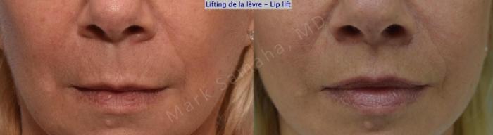 Before & After Lifting de la lèvre supérieure / Lip Lift  Case 169 Front View in Montreal, QC