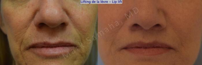 Before & After Lifting de la lèvre supérieure / Lip Lift  Case 170 Front View in Montreal, QC