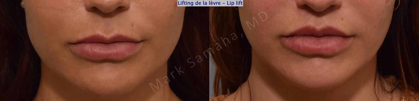 Before & After Lifting de la lèvre supérieure / Lip Lift  Case 171 Front View in Montreal, QC