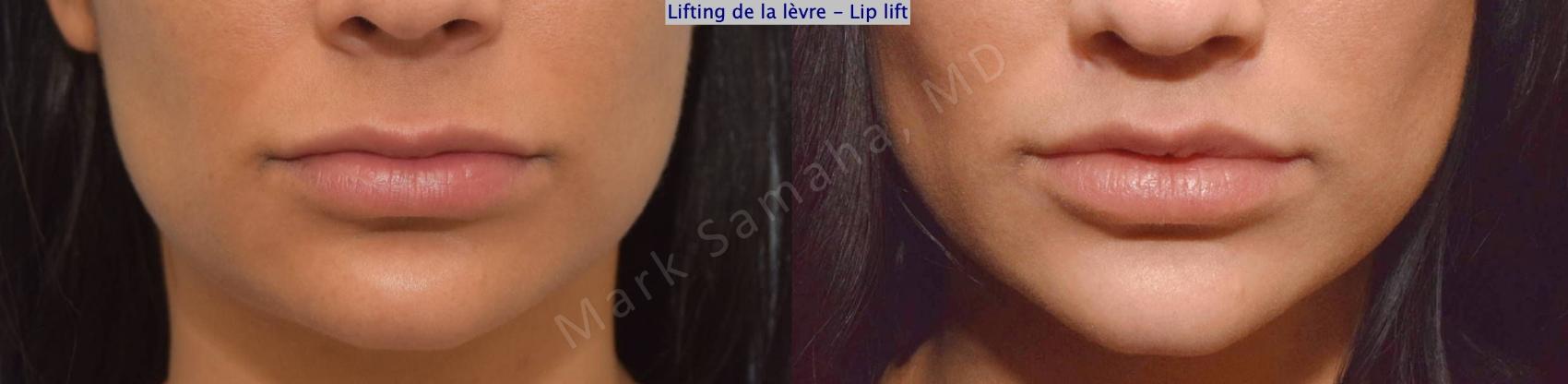 Before & After Lifting de la lèvre supérieure / Lip Lift  Case 172 Front View in Montreal, QC
