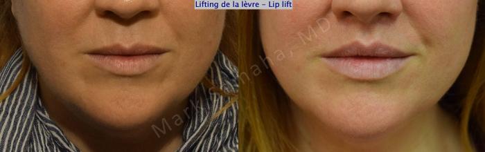 Before & After Lifting de la lèvre supérieure / Lip Lift  Case 173 Front View in Montreal, QC