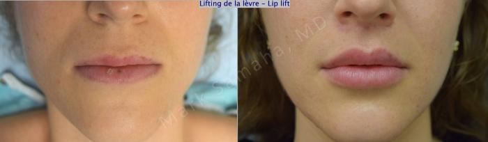 Before & After Lifting de la lèvre supérieure / Lip Lift  Case 174 Front View in Montreal, QC