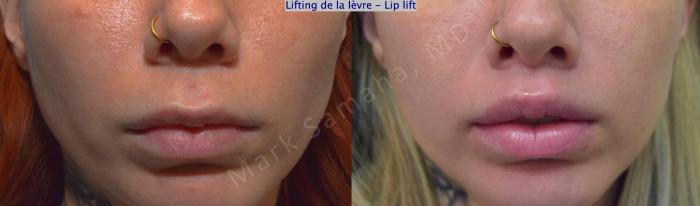 Before & After Lifting de la lèvre supérieure / Lip Lift  Case 176 Front View in Montreal, QC