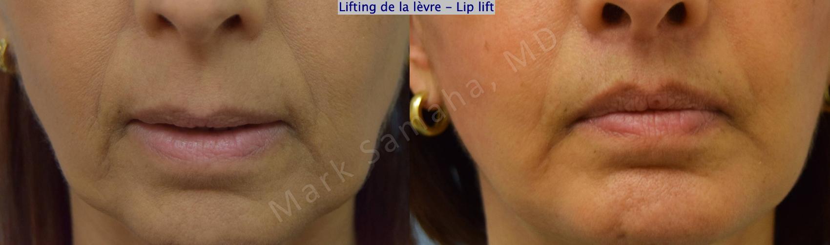 Before & After Lifting de la lèvre supérieure / Lip Lift  Case 196 Front View in Montreal, QC