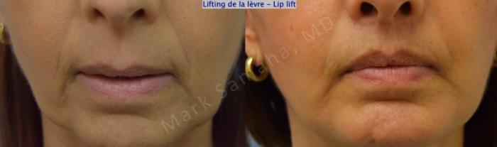 Before & After Lifting de la lèvre supérieure / Lip Lift  Case 196 Front View in Montreal, QC