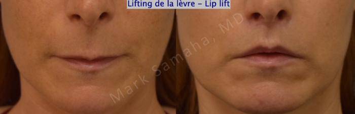 Before & After Lifting de la lèvre supérieure / Lip Lift  Case 197 Front View in Montreal, QC