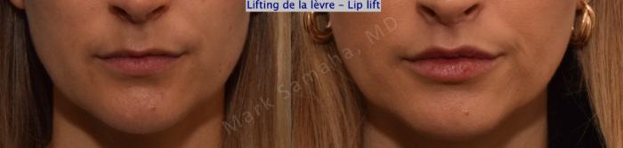 Before & After Lifting de la lèvre supérieure / Lip Lift  Case 199 Front View in Montreal, QC