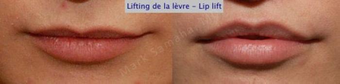 Before & After Lifting de la lèvre supérieure / Lip Lift  Case 23 View #1 View in Montreal, QC