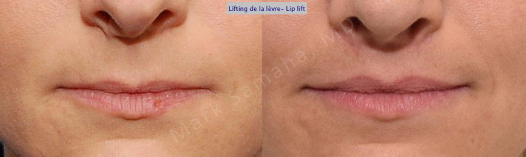 Before & After Lifting de la lèvre supérieure / Lip Lift  Case 25 View #1 View in Montreal, QC