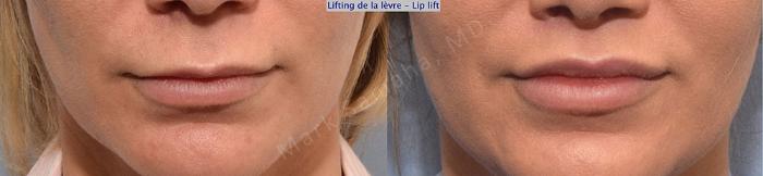 Before & After Lifting de la lèvre supérieure / Lip Lift  Case 26 View #1 View in Montreal, QC