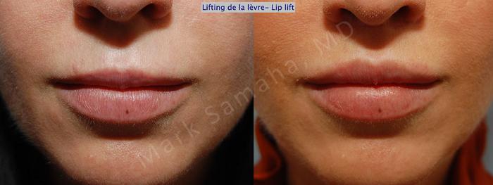 Before & After Lifting de la lèvre supérieure / Lip Lift  Case 27 View #1 View in Montreal, QC