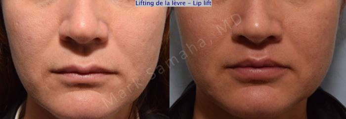 Before & After Lifting de la lèvre supérieure / Lip Lift  Case 70 View #1 View in Montreal, QC