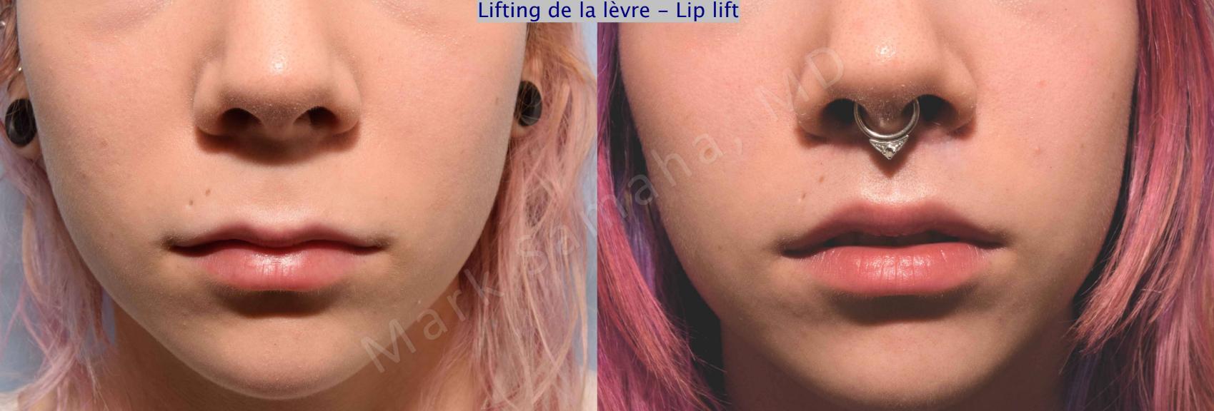 Before & After Lifting de la lèvre supérieure / Lip Lift  Case 71 View #1 View in Montreal, QC