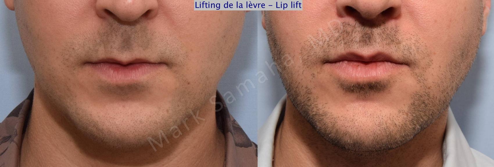 Before & After Lifting de la lèvre supérieure / Lip Lift  Case 72 View #1 View in Montreal, QC