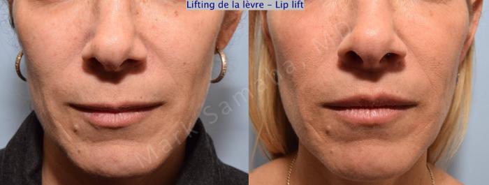 Before & After Lifting de la lèvre supérieure / Lip Lift  Case 73 View #1 View in Montreal, QC