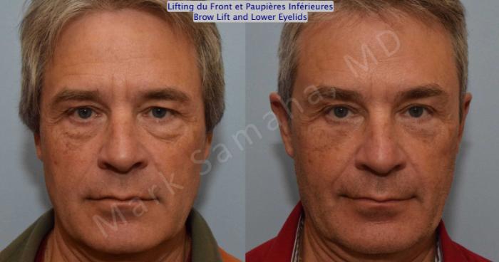 Before & After Blépharoplastie / Blepharoplasty Case 117 View #1 View in Montreal, QC