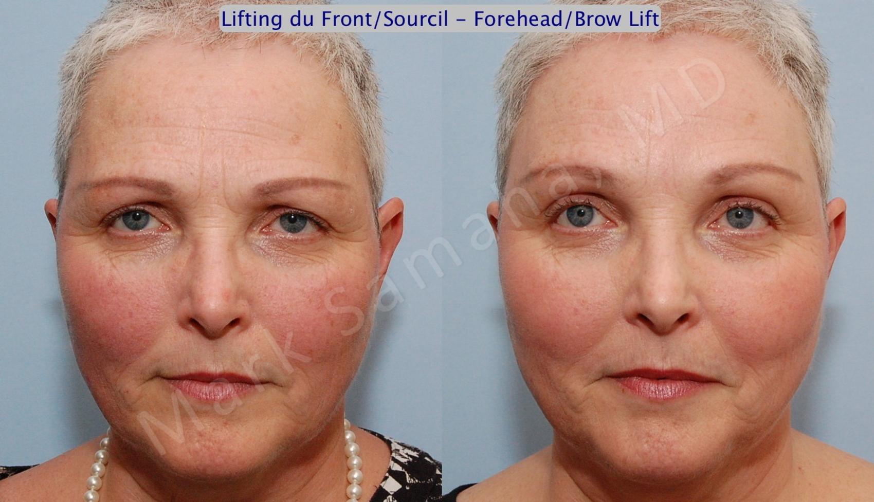 Before & After Lifting du Sourcil / Brow lift Case 87 View #1 View in Mount Royal, QC