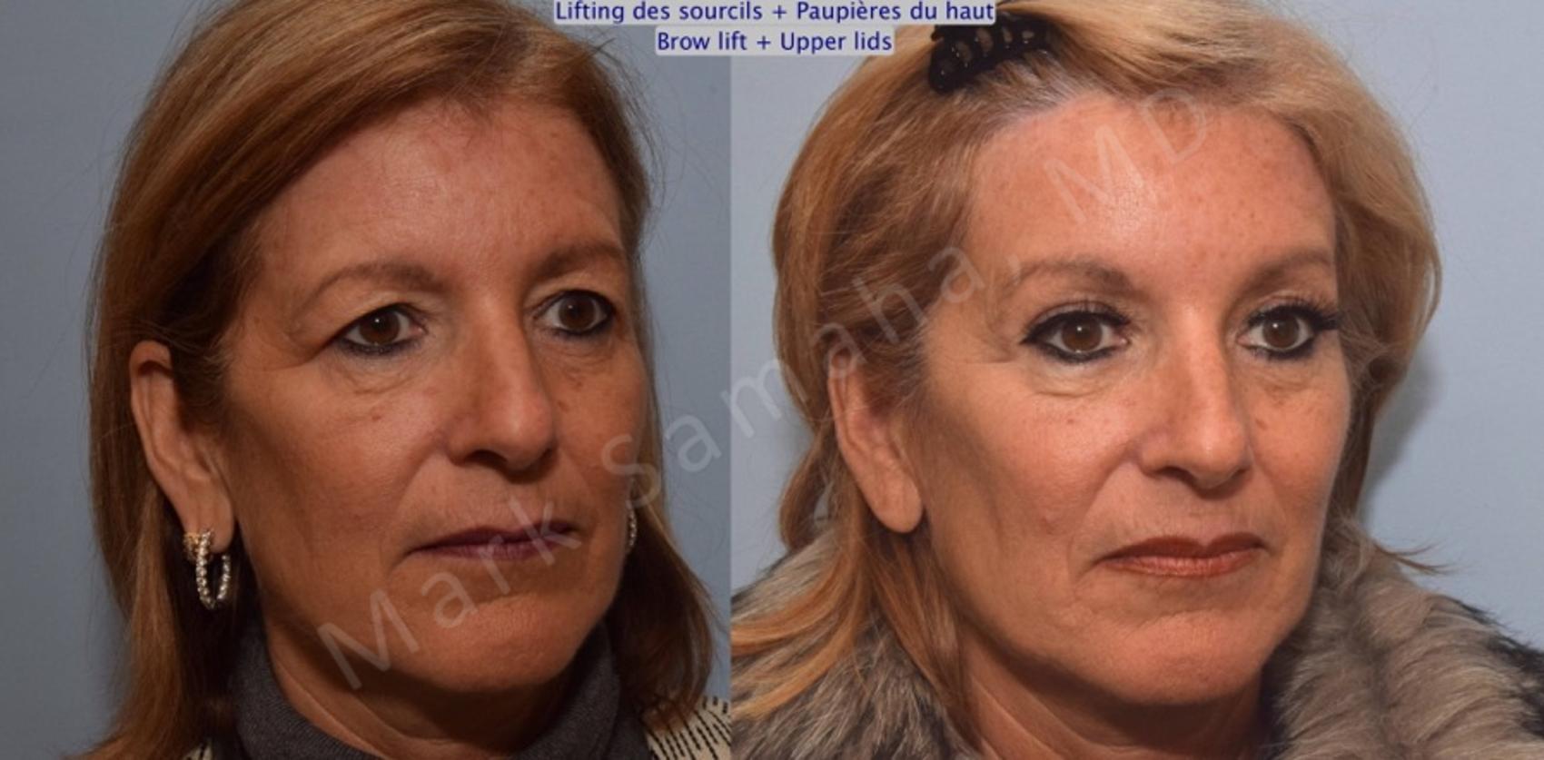 Lifting du Sourcil / Brow lift Avant & Après Photos / Before and After Pictures Case 90
