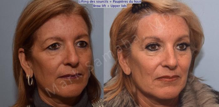 Before & After Lifting du Sourcil / Brow lift Case 90 View #4 View in Mount Royal, QC