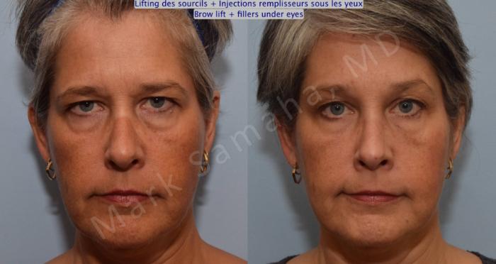 Before & After Lifting du Sourcil / Brow lift Case 97 View #1 View in Montreal, QC