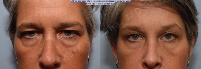 Before & After Lifting du Sourcil / Brow lift Case 97 View #4 View in Mount Royal, QC
