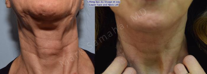 Before & After Lifting du visage / Cou - Facelift / Necklift Case 101 View #1 View in Mount Royal, QC