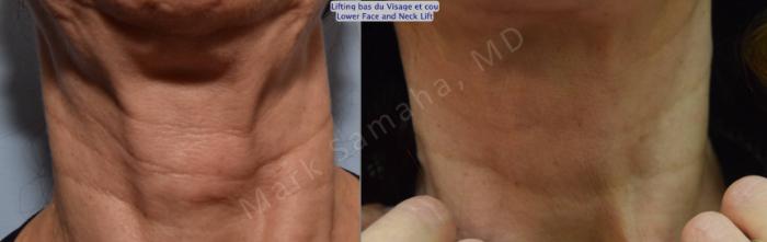 Before & After Lifting du visage / Cou - Facelift / Necklift Case 101 View #2 View in Montreal, QC