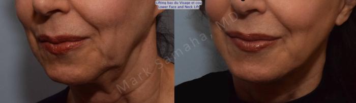 Before & After Lifting du visage / Cou - Facelift / Necklift Case 101 View #5 View in Montreal, QC