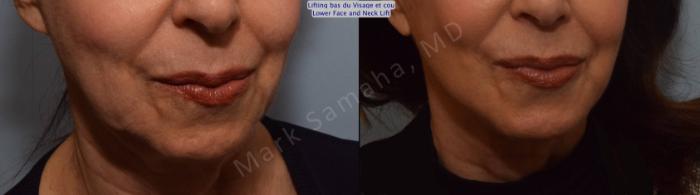 Before & After Lifting du visage / Cou - Facelift / Necklift Case 101 View #6 View in Montreal, QC