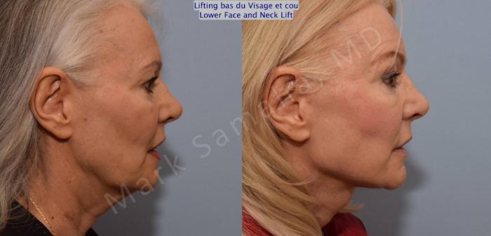 Before & After Lifting du visage / Cou - Facelift / Necklift Case 102 View #2 View in Mount Royal, QC