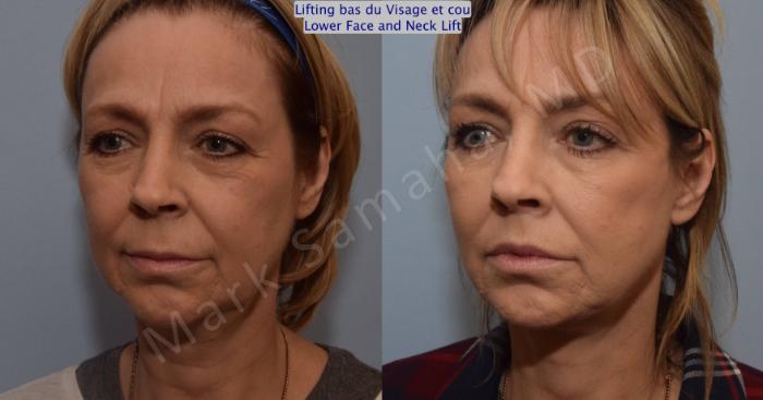 Before & After Lifting du visage / Cou - Facelift / Necklift Case 103 View #3 View in Mount Royal, QC